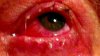 frag eye.jpg